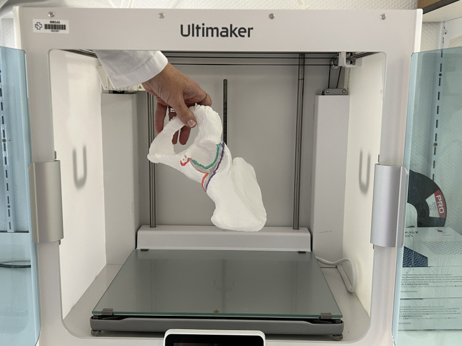 El Área Sanitaria de Ferrol emplea la impresión 3D para explicar las patologías a los pacientes