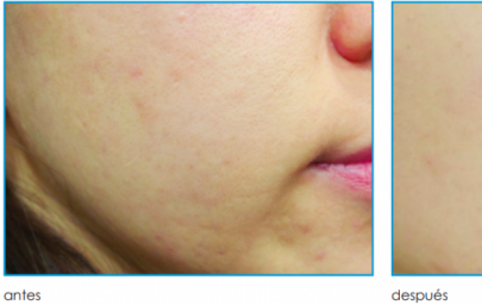 Como recuperar tu piel después del verano en COS Instituto Médico: dermatología, láser y estética