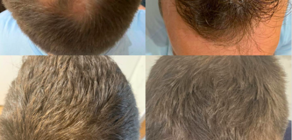 Descubre la tricología: la rama de los dermatólogos especialistas en cuidado del cabello y la caída capilar