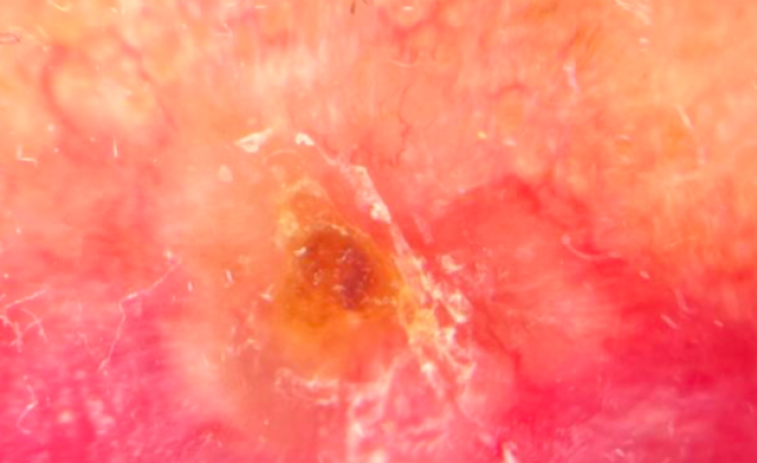 Carcinoma basocelular: más que una lesión cutánea común