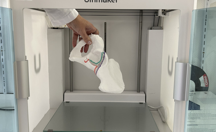 El Área Sanitaria de Ferrol emplea la impresión 3D para explicar las patologías a los pacientes