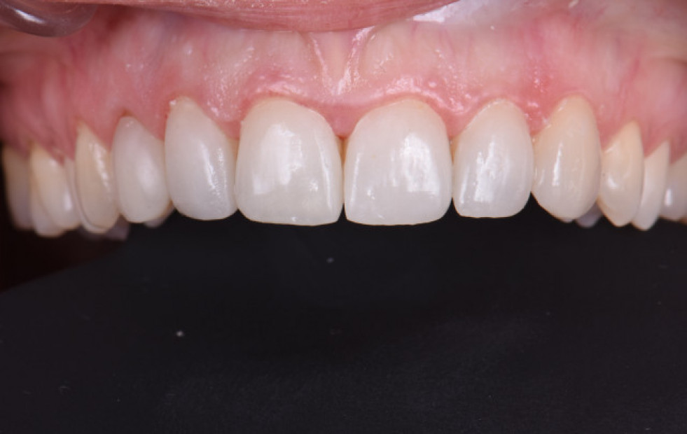 Microcarillas dentales: la clave para renovar sonrisa
