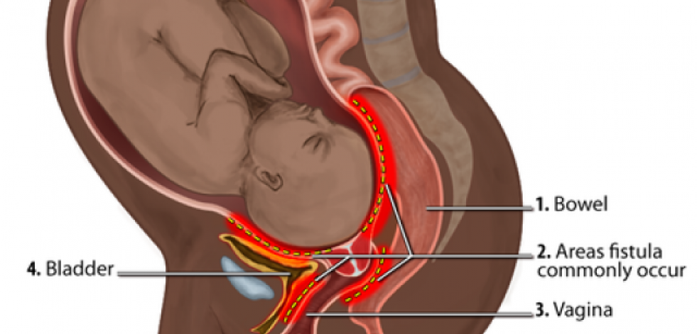 La fístula obstétrica, una lesión que afecta a mujeres en situación de pobreza